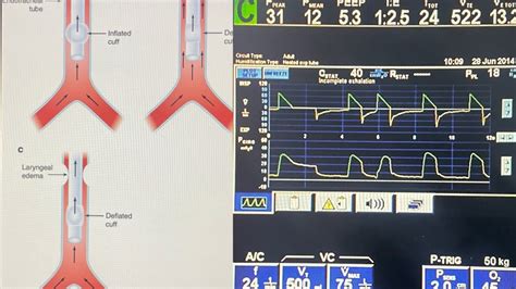 Cuff Leak Test • LITFL • CCC Airway